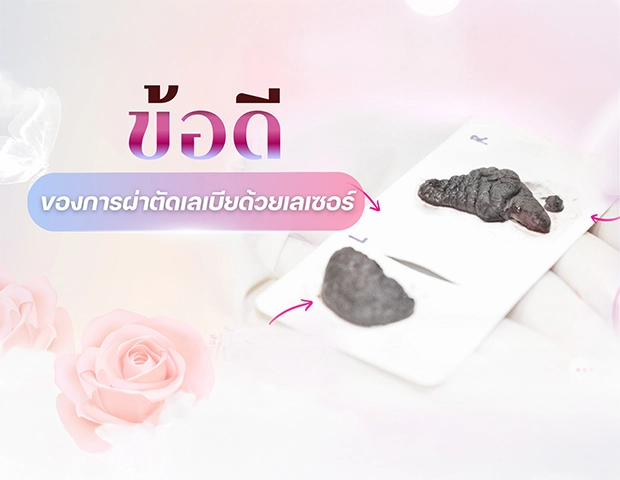 ข้อดีของการผ่าตัดเลเบียด้วยเลเซอร์