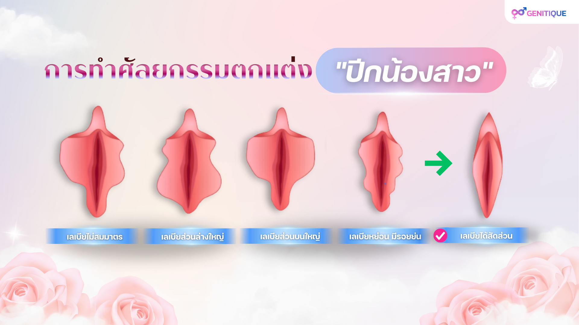 การทำศัลยกรรมตกแต่งตัดปีกน้องสาว