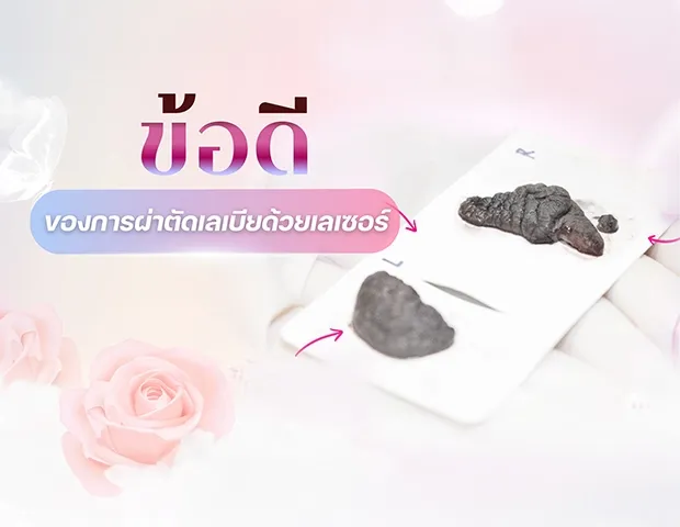 ข้อดีของการผ่าตัดเลเบียด้วยเลเซอร์